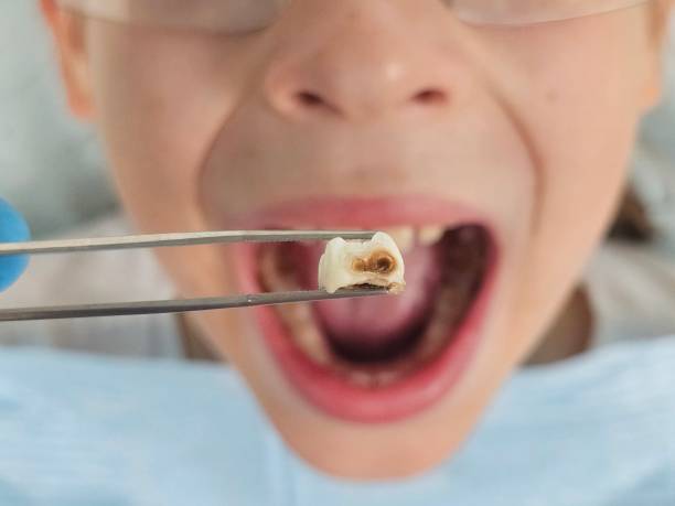 Best Emergency Root Canal Treatment in Han, GA